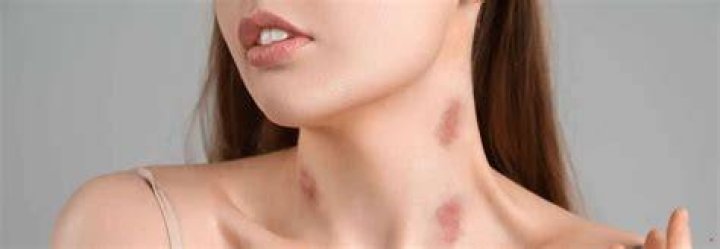 Are hickeys inappropriate?