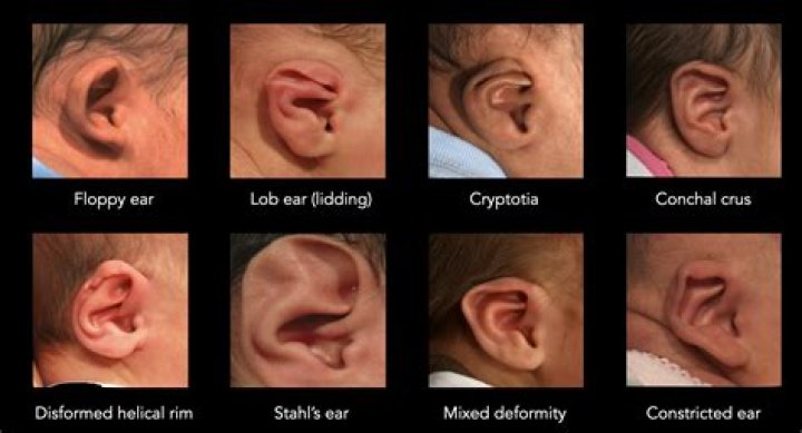 Are stick out ears genetic?
