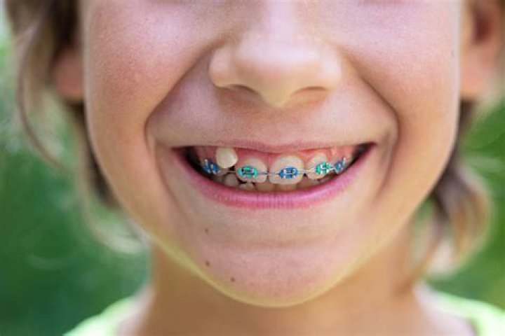 Can a 5 year old get braces?