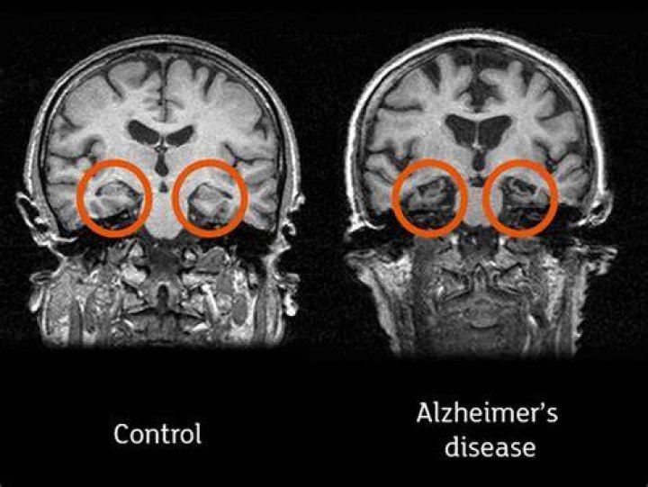 Can a brain MRI show dementia?