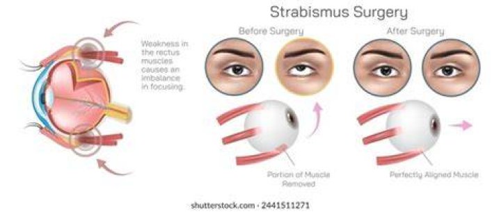 Can a person with strabismus drive?