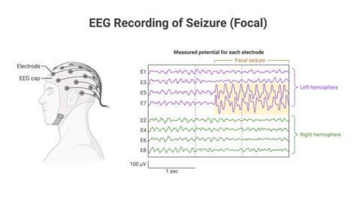Can an EKG show seizures?