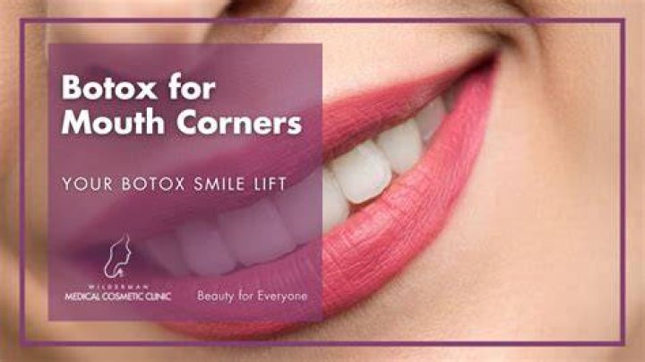 Can Botox help the corners of your mouth?