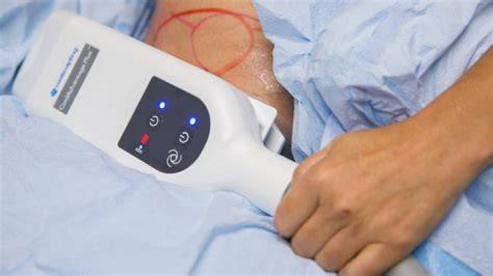 Can CoolSculpting give you curves?