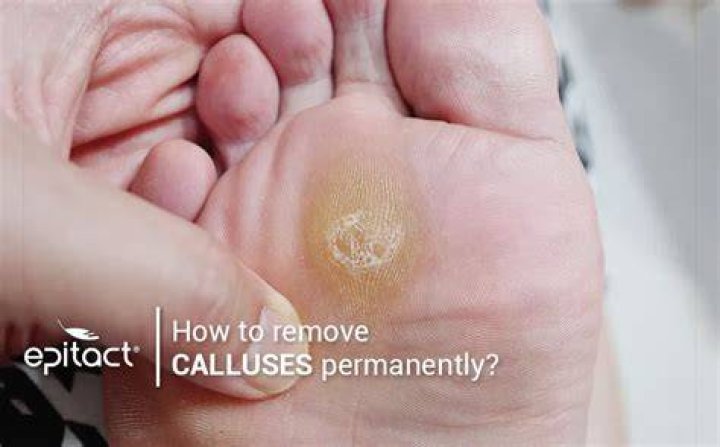Can foot calluses be permanently removed?