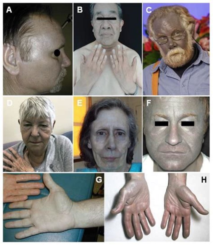 Can hemochromatosis affect your feet?