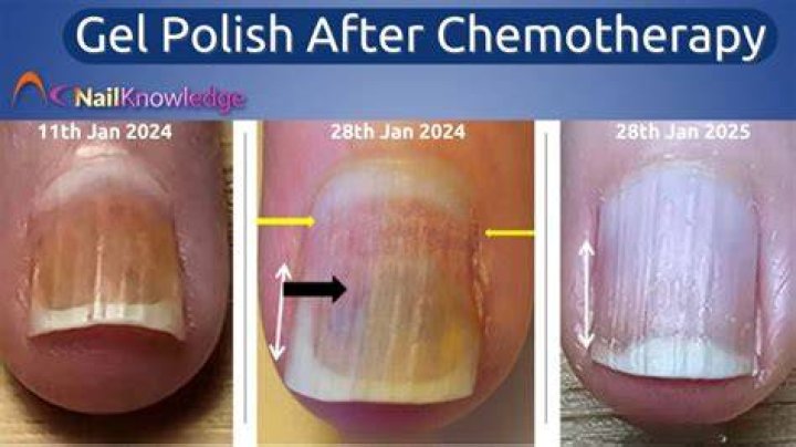 Can I use nail polish while on chemo?