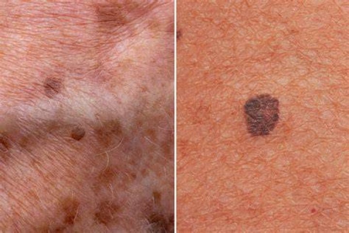 Can melanoma cause hot flashes?
