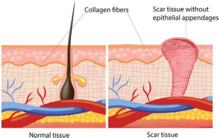 Can scar tissue continue to grow?