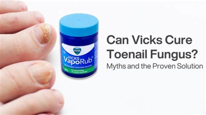 Can Vicks cure toenail fungus?