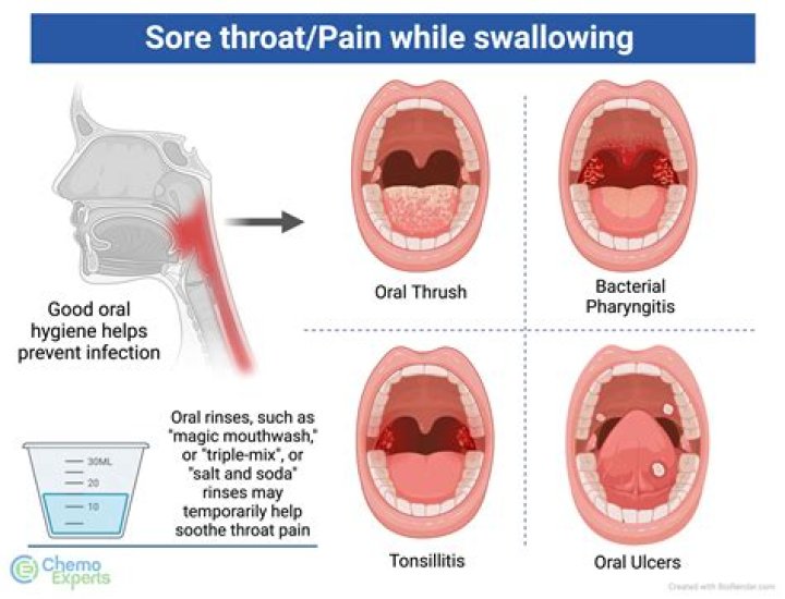 Can you get a sore throat from a bonfire?