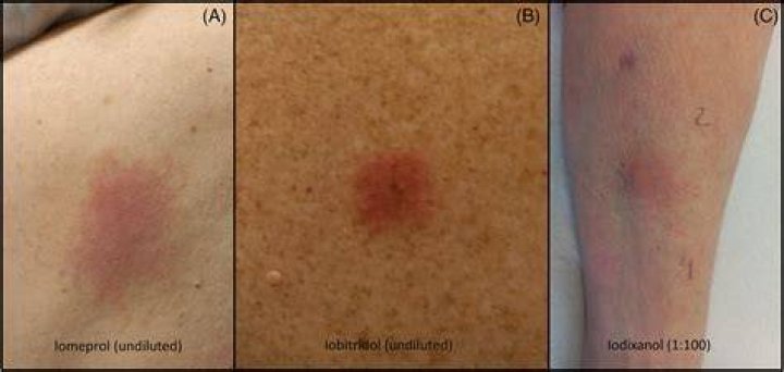 Can you have a delayed reaction to contrast dye?