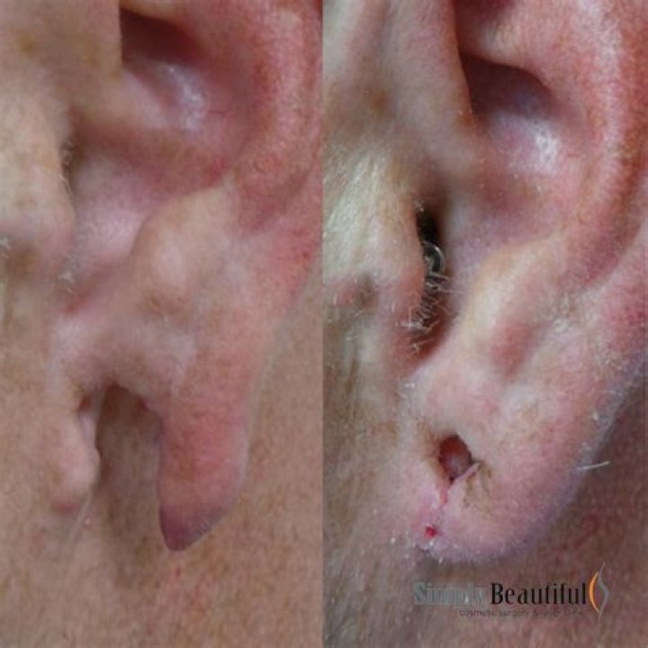 Can you stitch a split ear?