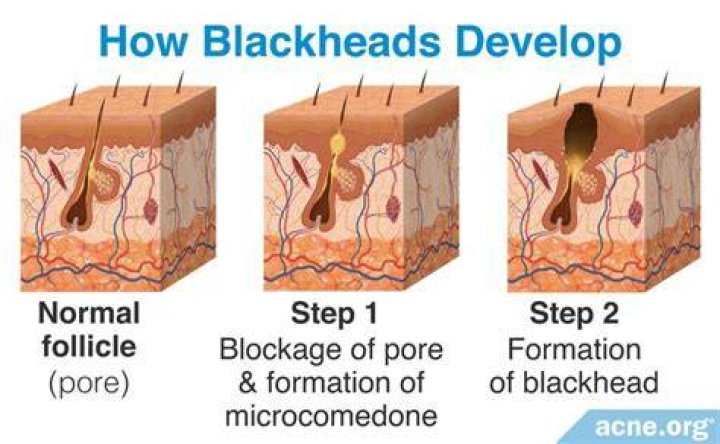 Do blackheads go away with age?