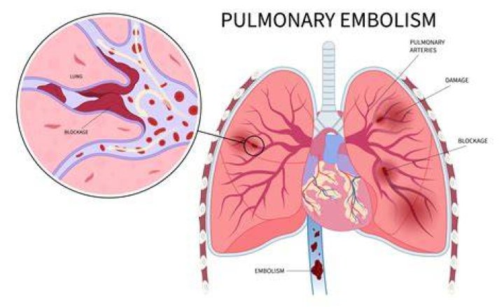 Do lungs heal after pulmonary embolism?