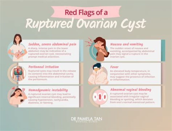 Do ovarian cysts rupture during your period?