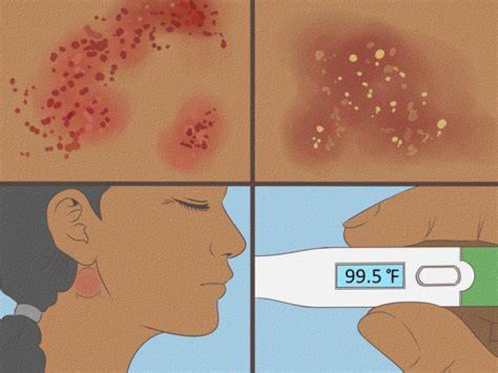 Does heat rash go away on its own?