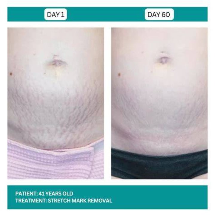 Does Johnson oil remove stretch marks?