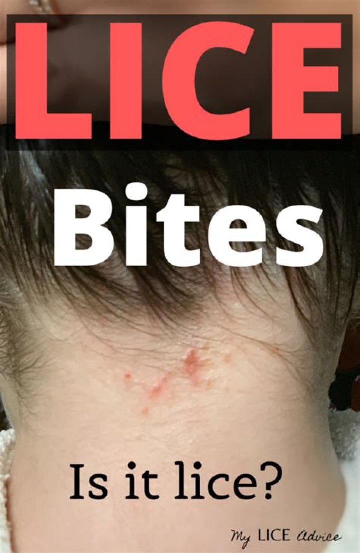 Does lice bite your neck?