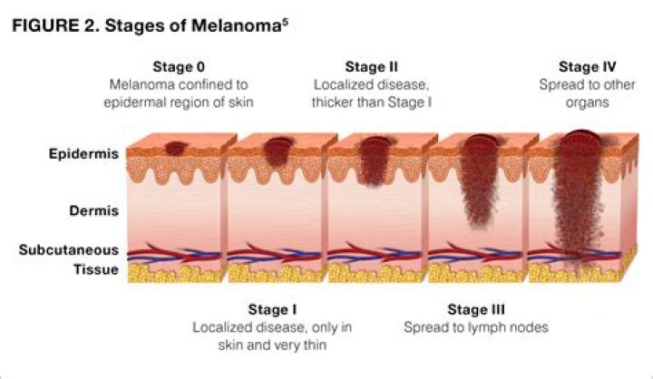 Does melanoma hurt to the touch?