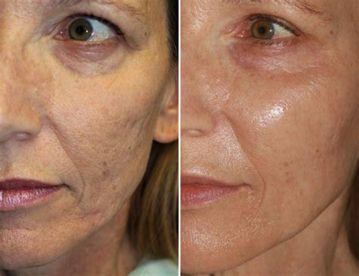 Does microneedling help mature skin?