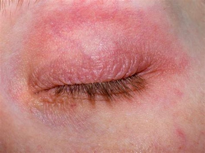How do I get collagen back into my eyelids?