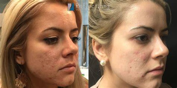 How do you lighten skin after microneedling?