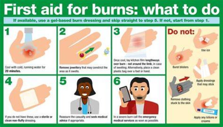 How do you stop a burn from throbbing?