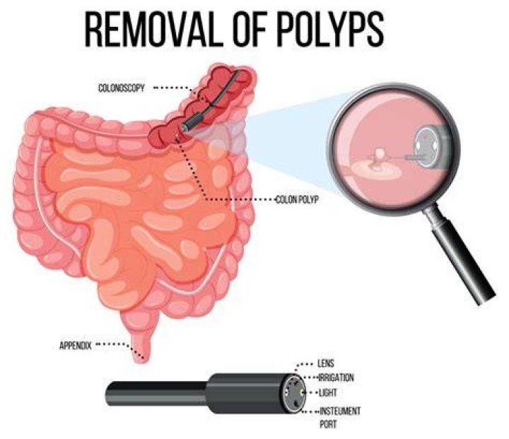 How is a very large polyp removed?