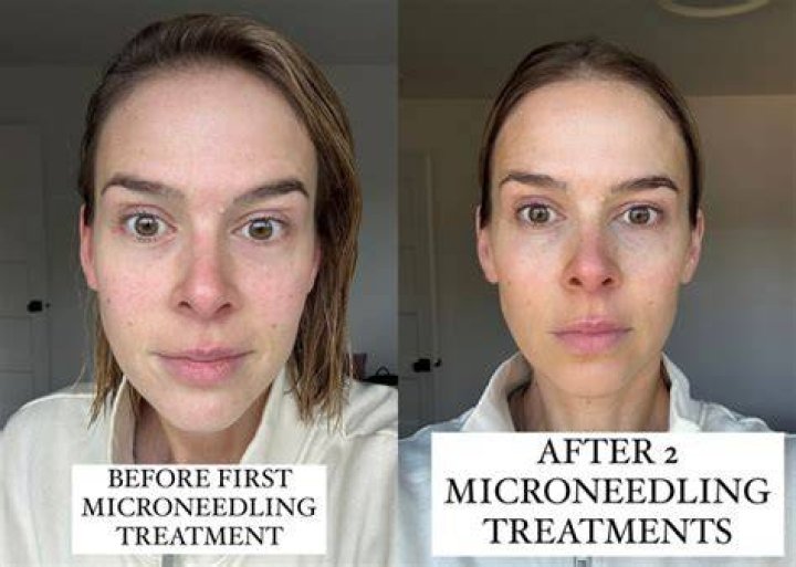 How long after microneedling do you see results?