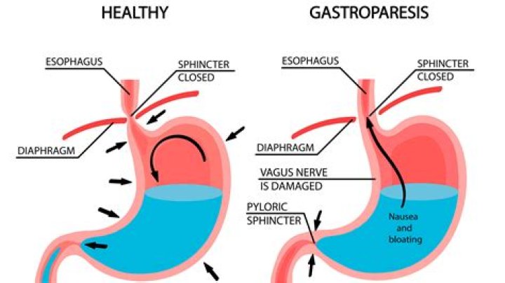 How long does it take gastroparesis to heal?