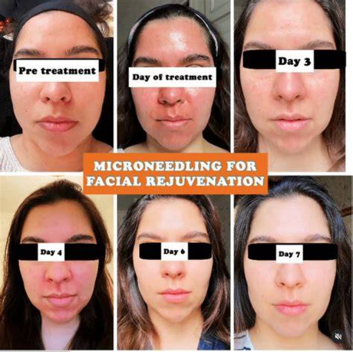 How long should I microneedle my face?