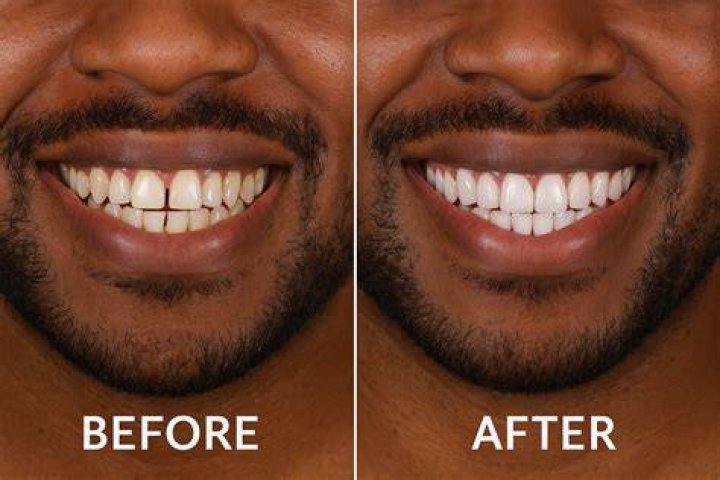 Is 65 too old for veneers?