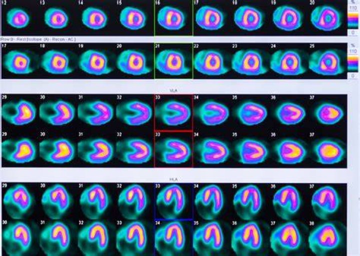 Is a heart scan better than a stress test?