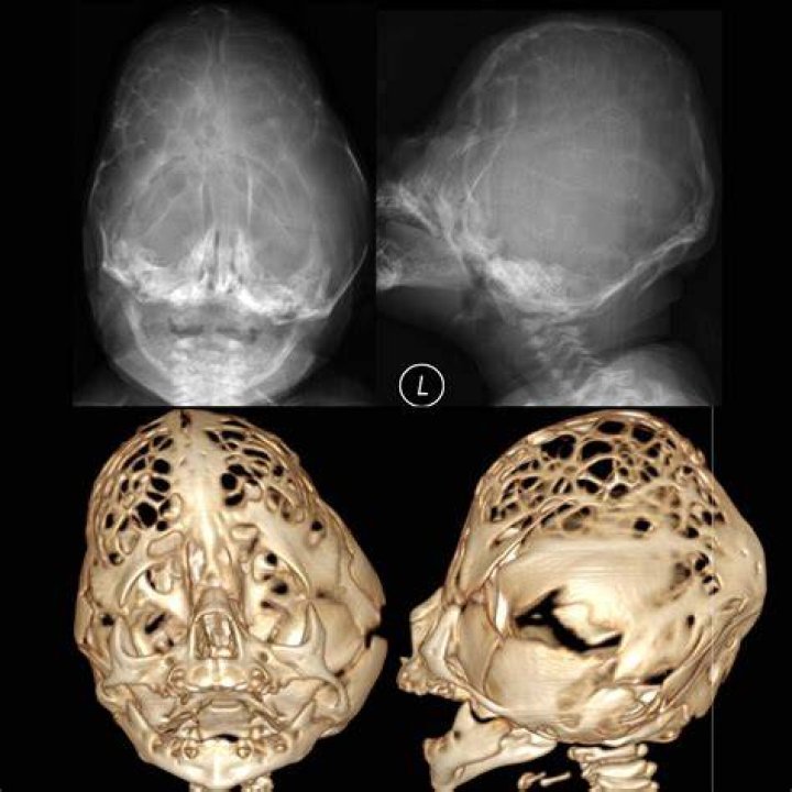 Is Cloverleaf syndrome fatal?