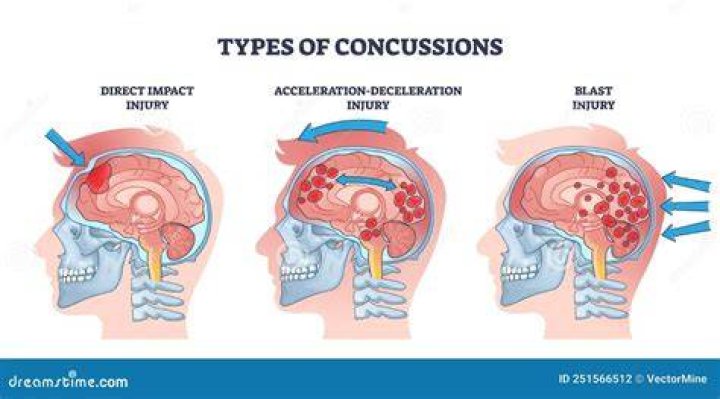 Is every bump on the head a concussion?