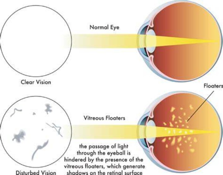 Is it normal to have floaters in your eyes?
