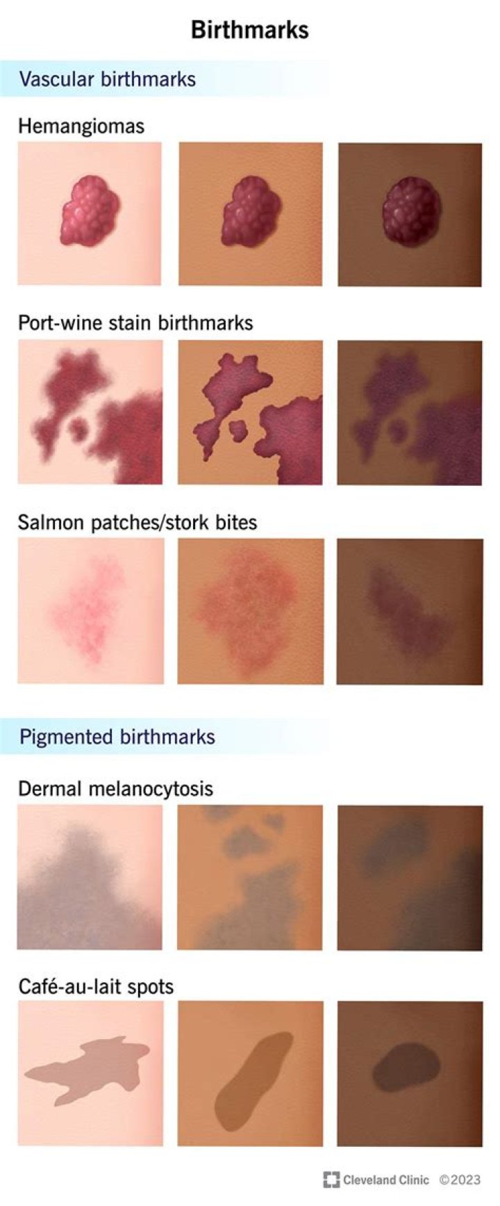 Is it rare to not have a birthmark?