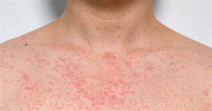 Should I see a doctor for a rash?