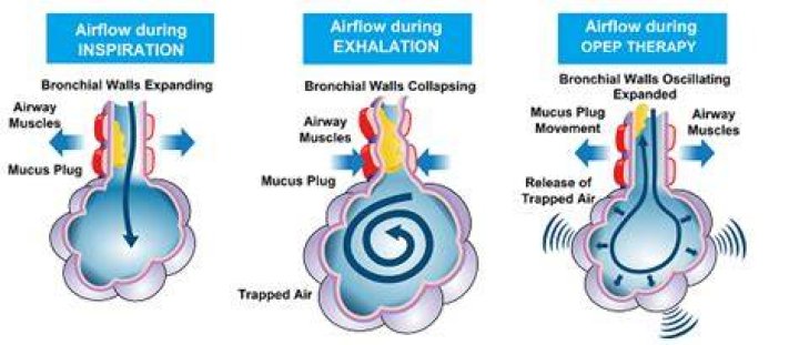 What causes air trapping?