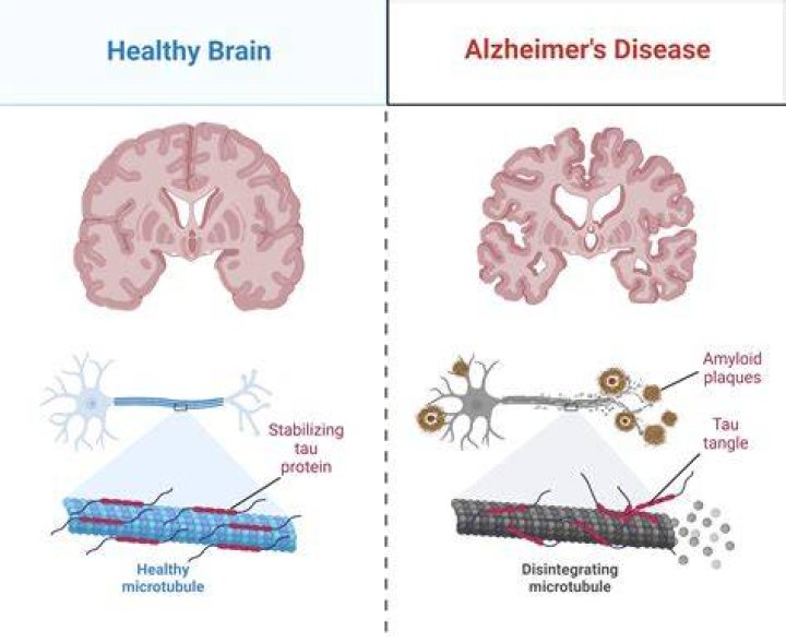 What causes early onset Alzheimer's disease?