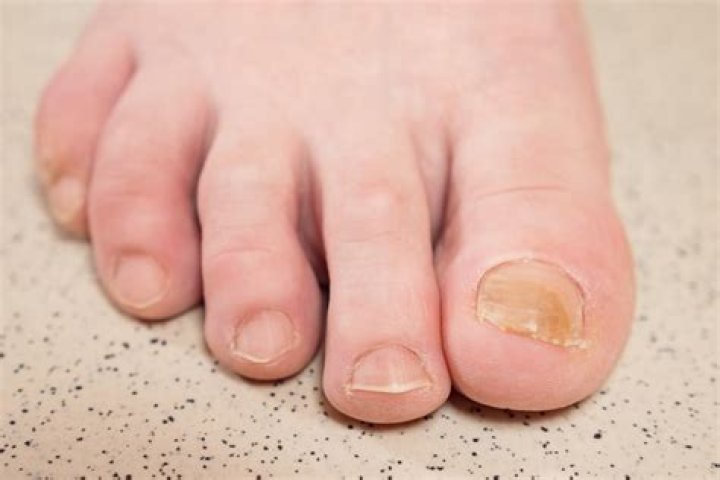 What color are toenails supposed to be?