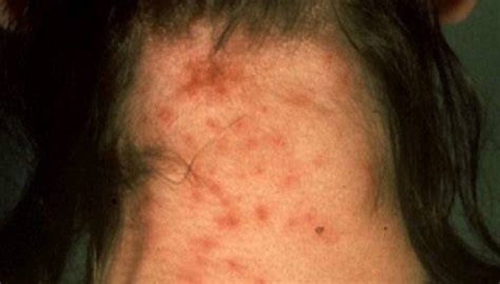 What do head lice bites look like?