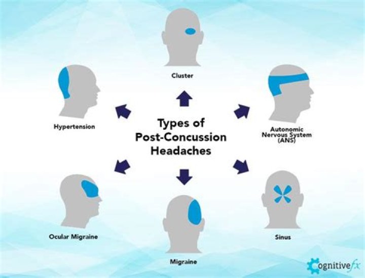 What does a concussion headache feel like?