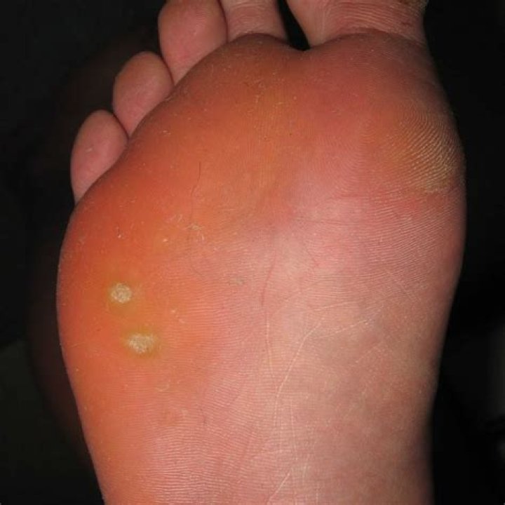 What does a wart on bottom of foot look like?
