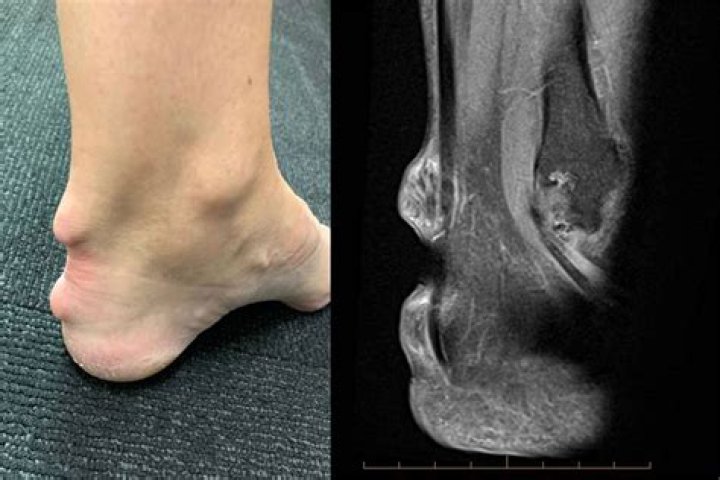 What does rheumatoid arthritis feel like in ankles?