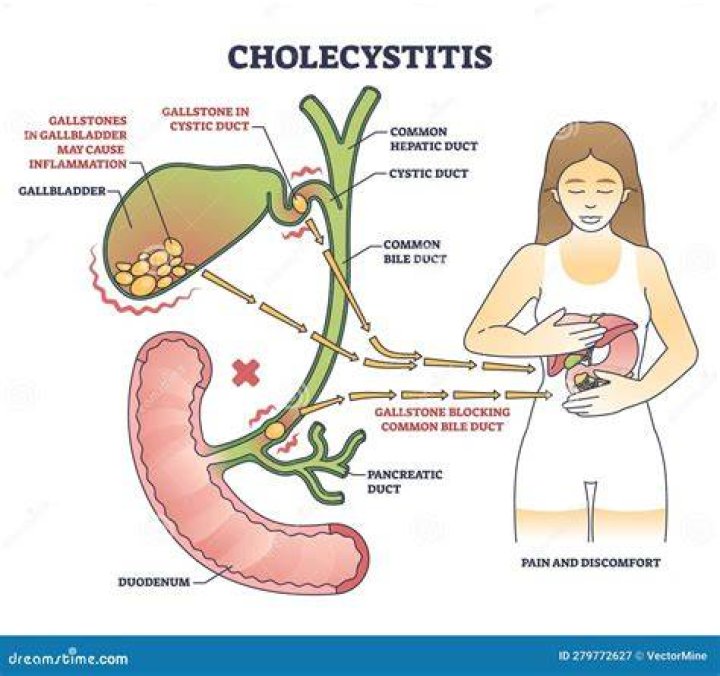 What is a classic symptom of cholecystitis?