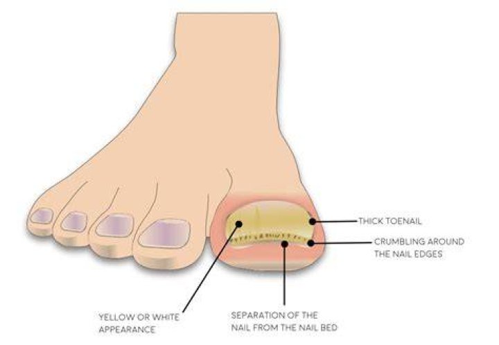 What is a sixth toenail?