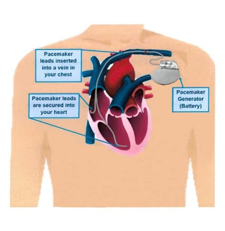 What is an alternative to a pacemaker?
