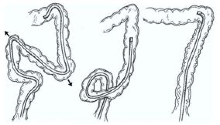 What is looping in colonoscopy?